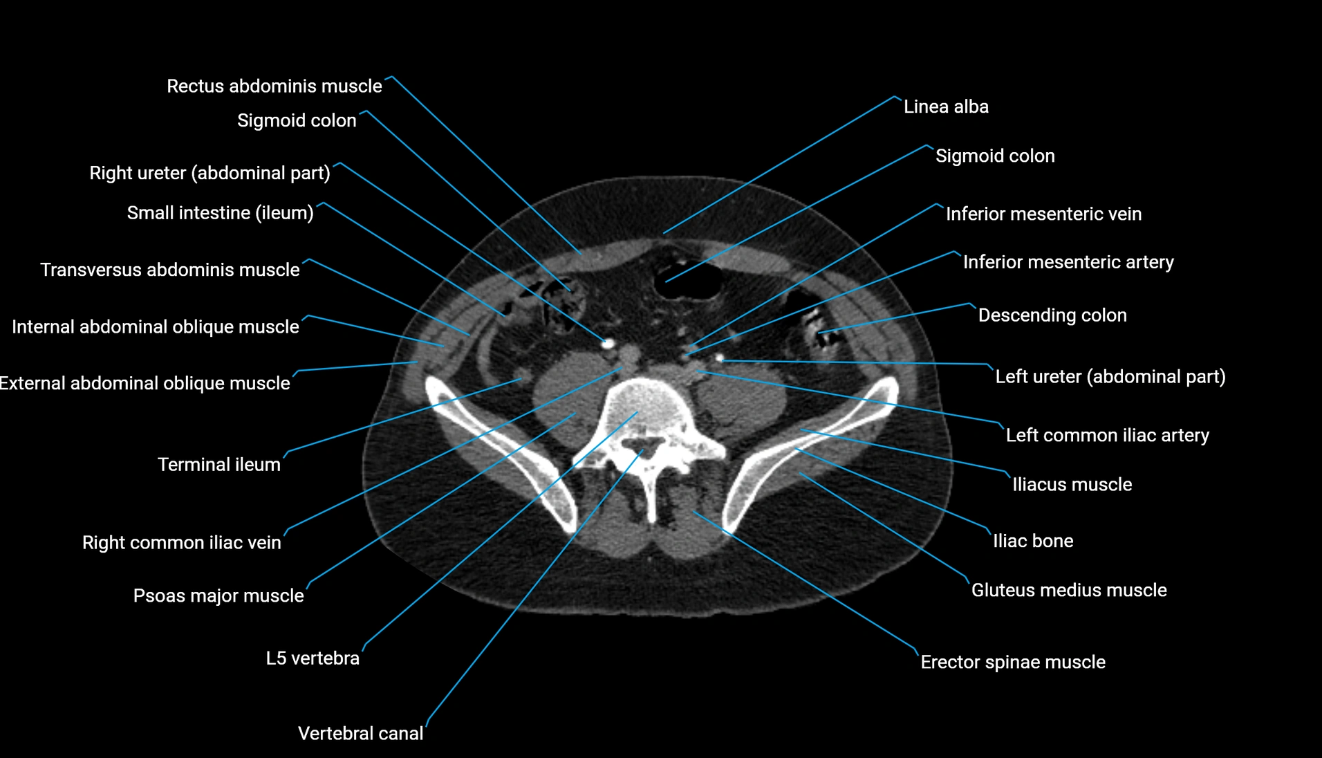 CT urogram axial cross sectional anatomy  labelled radiology image-00167.webp